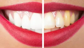 Anota estos remedios que no fallan para blanquear los dientes
