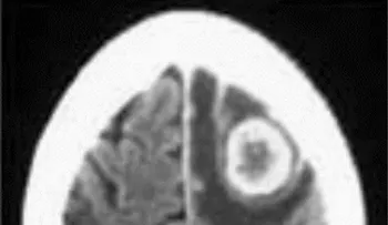 Cáncer de mama hace metástasis en el cerebro