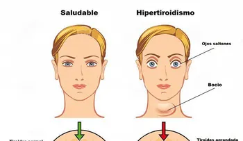 5 Remedios caseros para tratar el hipertiroidismo