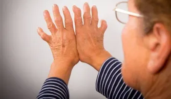 Diagnóstico temprano de la artritis reumatoide evita la incapacidad de los pacientes 