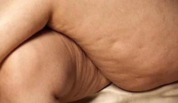 Cepillado en seco para ayudar a eliminar la celulitis