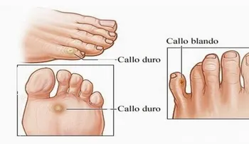 Los callos se te quitan para SIEMPRE con este simple remedio