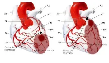 ¿Por qué ocurre un infarto fulminante? 