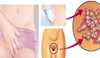 Enrojecimiento y picazon en tu vagina: Signos que nunca debes ignorar
