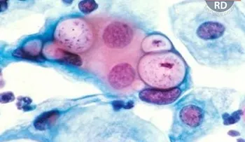 ¿Sabes lo que es la clamidiasis?