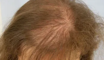 Alopecia: Perdida del cabello anormal que no distingue sexo