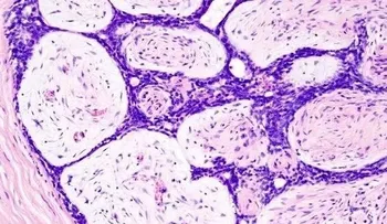  Descubren más de 70 variantes genéticas que elevan riesgo de cáncer de mama 