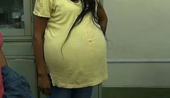 Extraen un tumor de 16 kilos a una mujer en Perú