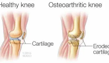 Salud: Tratamiento de la osteoporosis