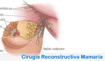 Cirugía estética de aumento de los senos