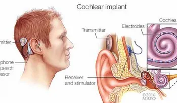 Los implantes cocleares pueden ser una alternativa 