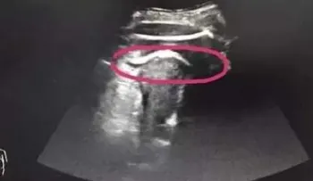  Un bebé le perfora el útero de su madre de una patada que casi la mata