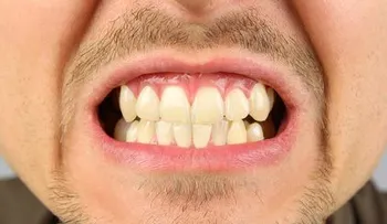 ¿A qué se debe el color de los dientes?