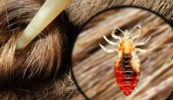 Si sueña con piojos significa que puede tener malas compañías a tu alrededor 