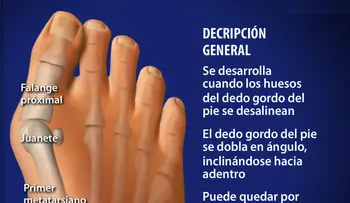 8 excelentes pasos que no FALLAN para quitar juanetes en los pies