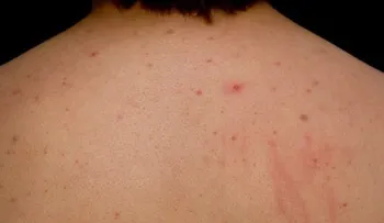 Cómo quitar el acné del cuello y la espalda