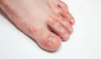 ¿Hongos en los pies? ¡3 remedios para eliminarlos definitivamente!