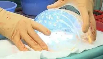 Trasplantan un cráneo impreso en 3D a una niña con hidrocefalia