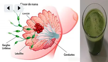 En la lucha contra el cáncer este es el único jugo que destruye el cáncer de mama