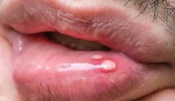 Cuando me salen llagas en la boca las elimino desde el primer día. Es sorprendente