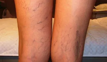 Trucos para disimular las incómodas várices