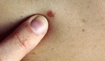 6 señales para identificar el cáncer en la piel
