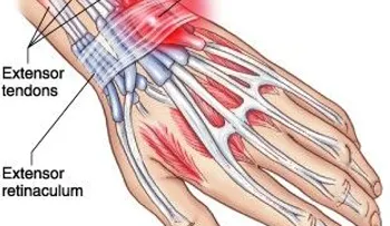 Cómo acabar con el fantasma de la tendinitis