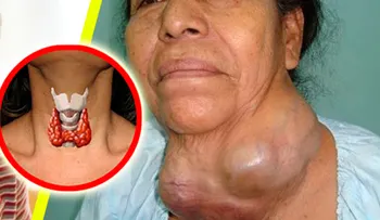La cura de la tiroides la tienes en tu casa y los doctores nos la ocultan