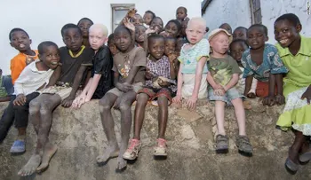 Caza de seres humanos: niños albinos de Malawi son asesinatos para vender sus huesos