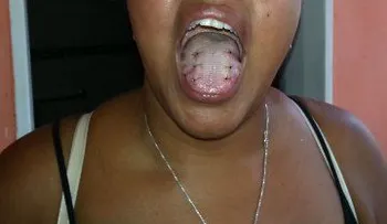 Le implantaron un parche en la lengua para que no puedas tragar