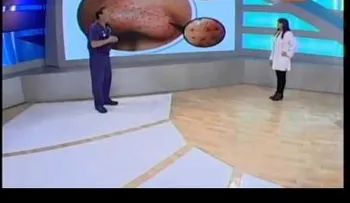 Las espinillas pueden poner en riesgo nuestra salud