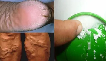 En 10 días, este remedio te cura los talones agrietados callos y venas varicosas 