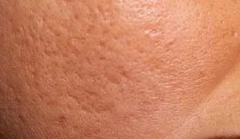  3 Remedios naturales para las cicatrices del acné 