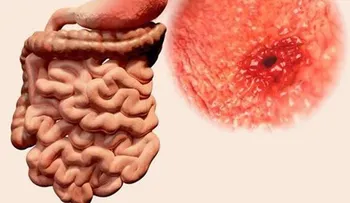 ¿La gastritis puede causar cáncer de estómago?. Por qué aparece y qué relación tienen