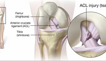 Algunas actividades aumentan el riesgo para lesiones en el ligamento cruzado anterior