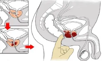 Como el jengibre destruye la próstata, el cáncer de colon y de ovario. Es mejor que la quimioterapia !!
