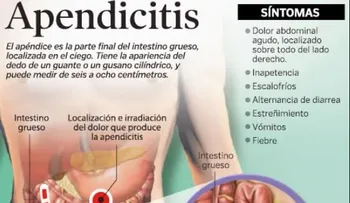 Apendicitis; causas, síntomas y tratamiento