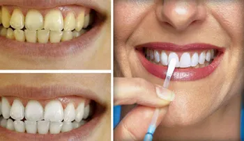 Los dentistas ocultan esto. El método más rápido y eficaz para blanquear dientes
