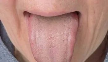 Los mejores remedios para tratar la lengua blanca