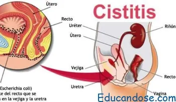 8 remedios para curar la cistitis