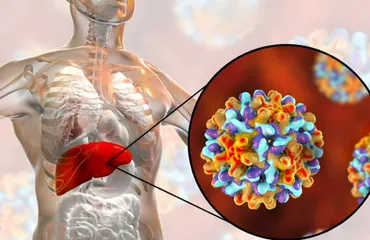 Hepatitis B y C: infecciones silenciosas que dañan el hígado sin aviso