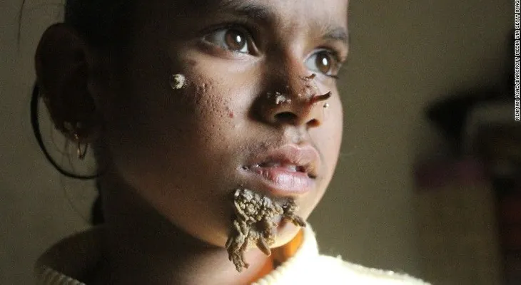 Niña de Bangladesh tiene síndrome del "hombre-árbol"