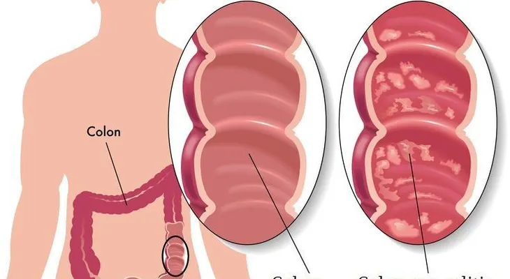 Colitis ulcerosa, y cómo superar esta enfermedad