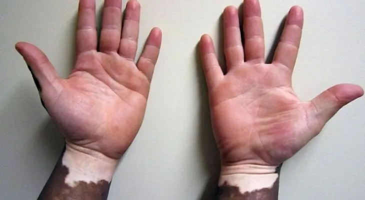 El vitiligo se puede tratar con remedios naturales; hojas de margosa, miel de abeja y aloe vera
