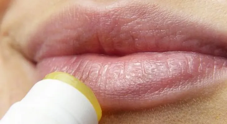 Herpes labial: síntomas y tratamiento