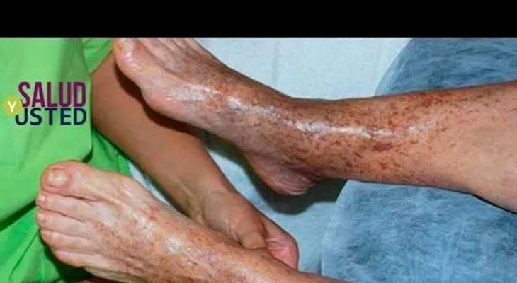Esta es la solución de 20 minutos para la mala circulación de la sangre!