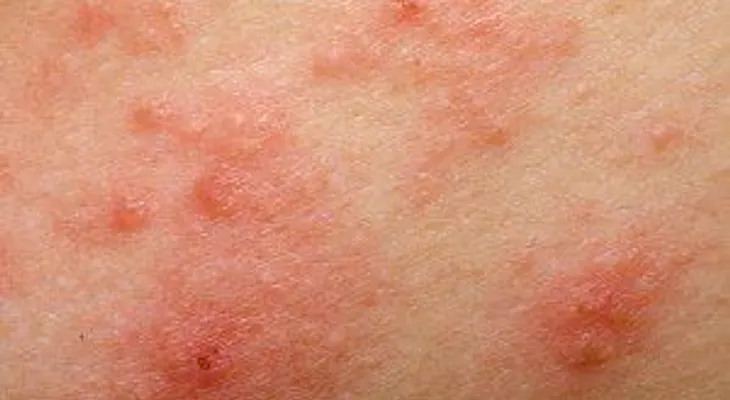 ¿Cómo saber si se trata de una reacción alérgica o una dermatitis?
