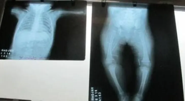 Hallan 7 agujas clavadas en bebé de 7 meses en Perú 