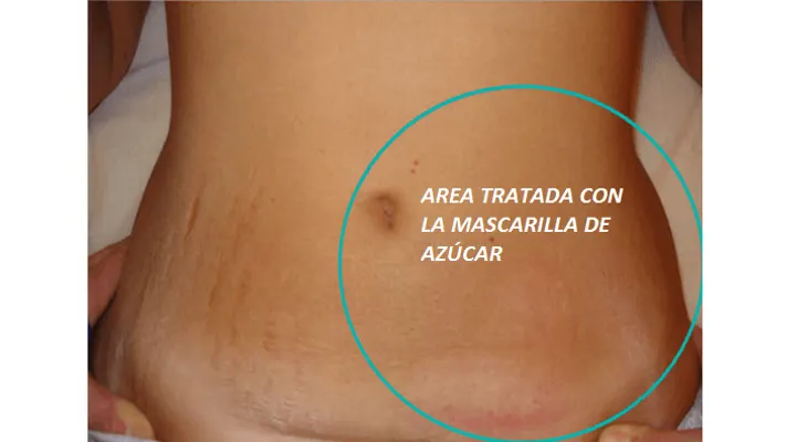 Cómo eliminar estrías con azúcar