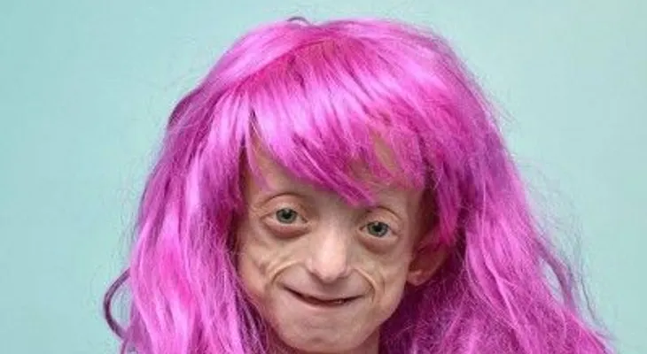 Tiene 11 años y padece una rara enfermedad